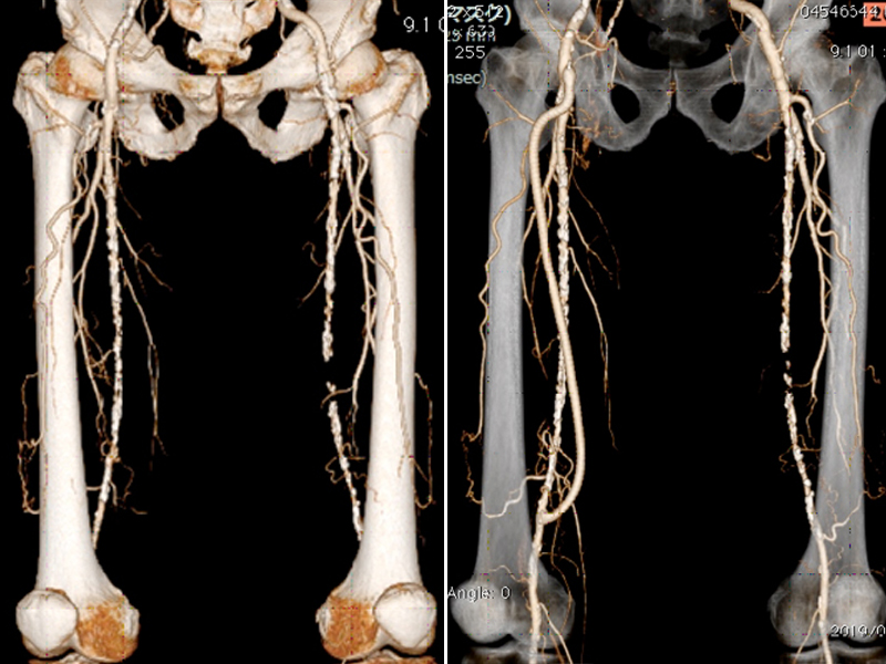 右大腿-膝窩動脈バイパス術、左大腿動脈血栓内膜摘除術施行