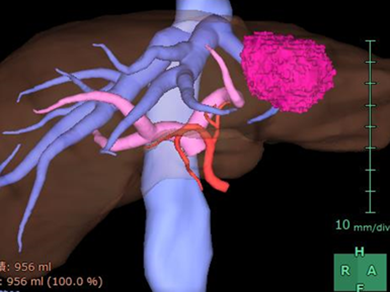 肝切除における3C-CTによるシミュレーション①