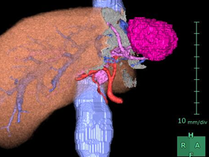 肝切除における3C-CTによるシミュレーション②