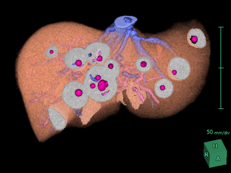 肝切除における3C-CTによるシミュレーション③