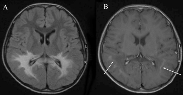 大脳型MRI画像